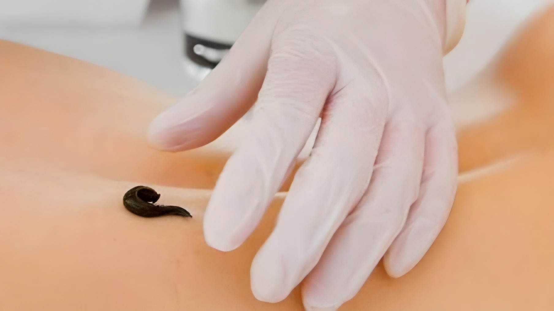 BAYANLARDA SÜLÜK TEDAVİSİ